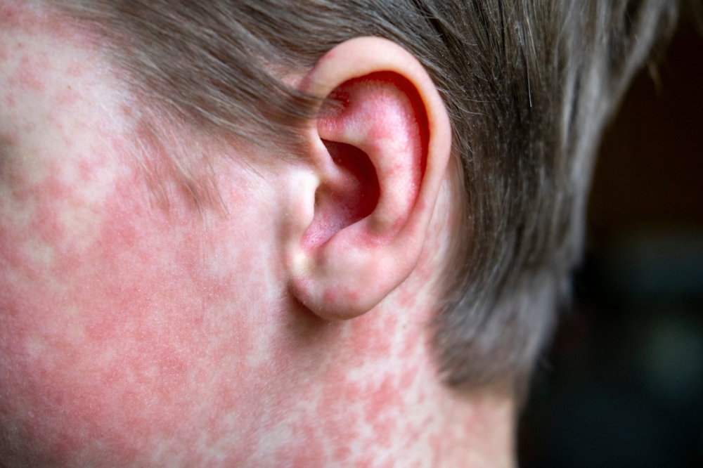 side of childs face with measles rash